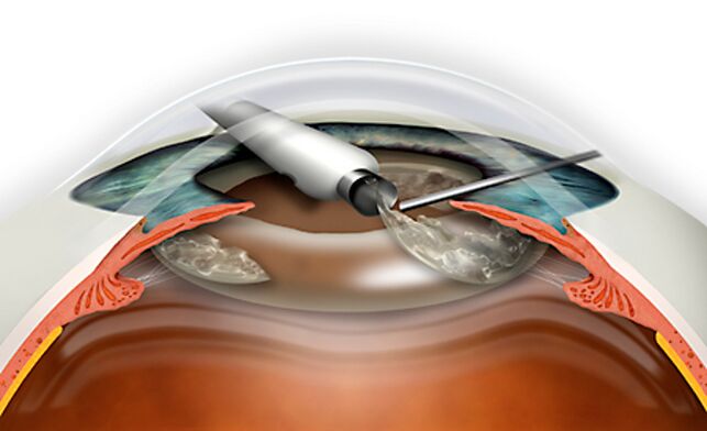 Refractive replacement of lenses is performed through microdecoration, excluding blood loss