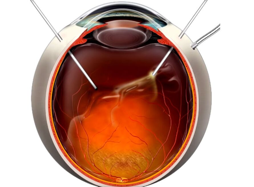 Vitrectomy - The procedure to show people when exfoliating the retinal